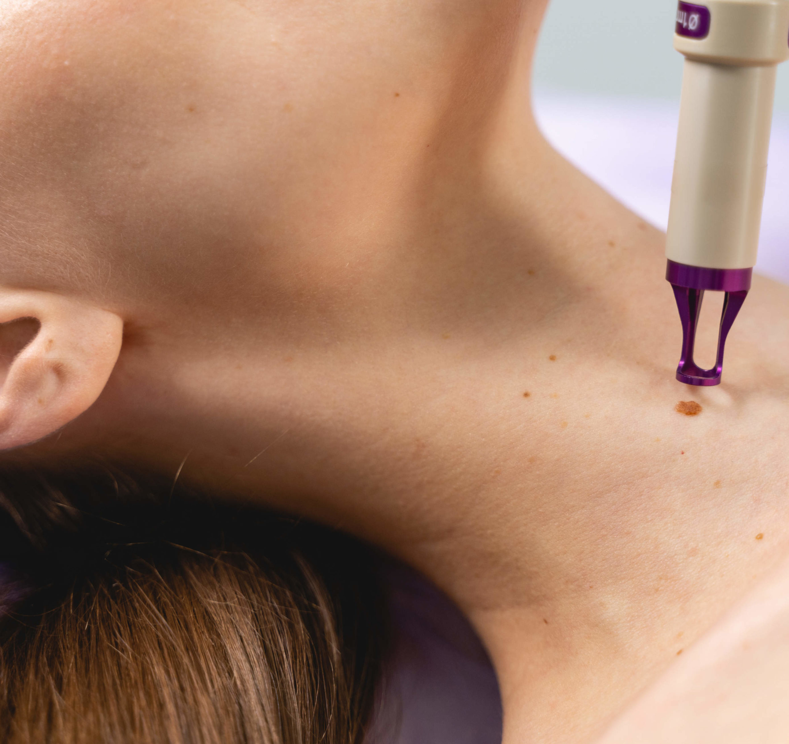 Laser Pigmentierte Läsionen Muttermale entfernen Behandlung Beauty Klinik