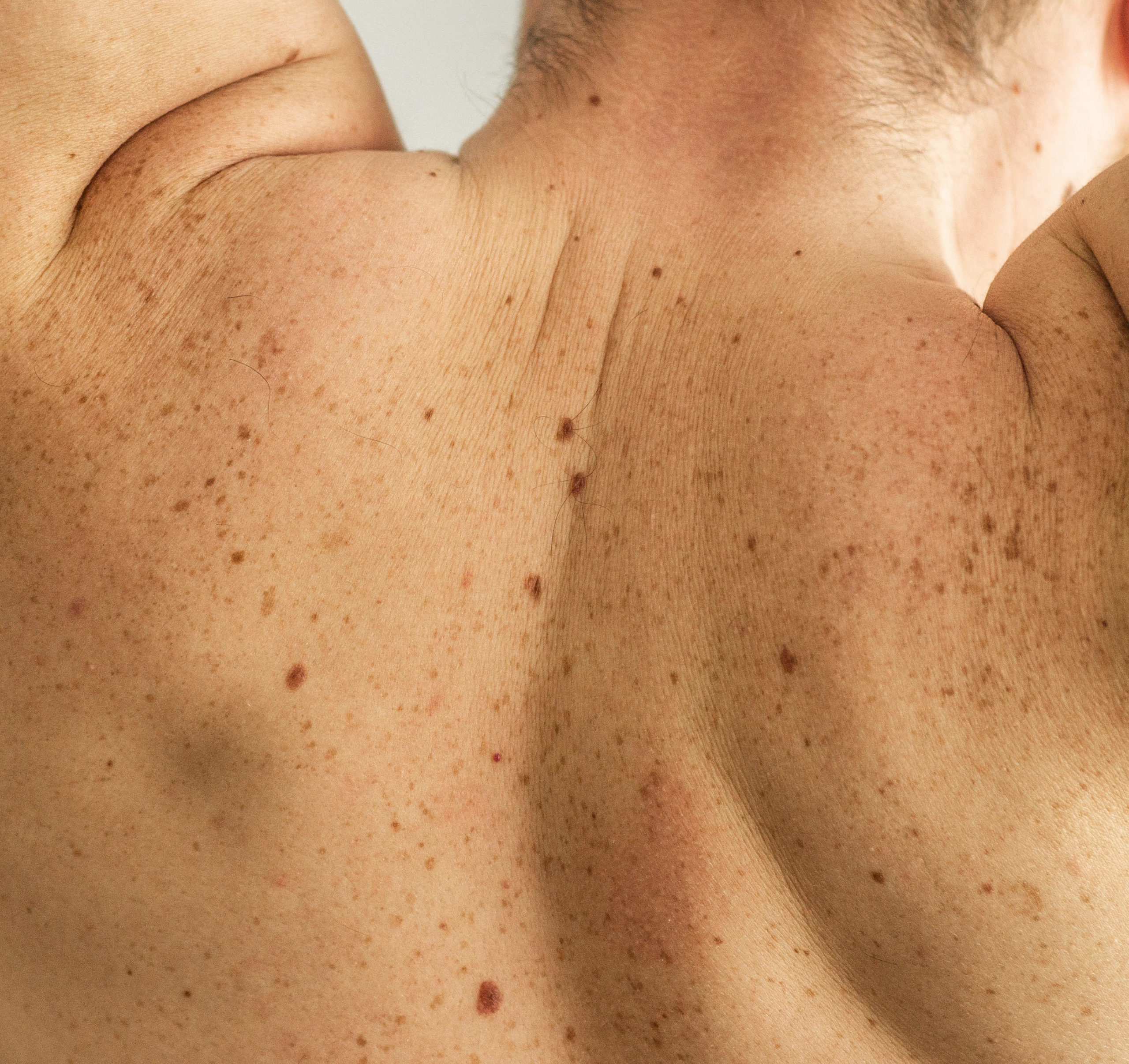Laser Pigmentierte Läsionen entfernen Muttermale Behandlung Beauty Klinik